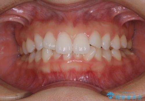 成人式の前撮り前に歯をきれいにしたい 初めてのPMTCの治療前