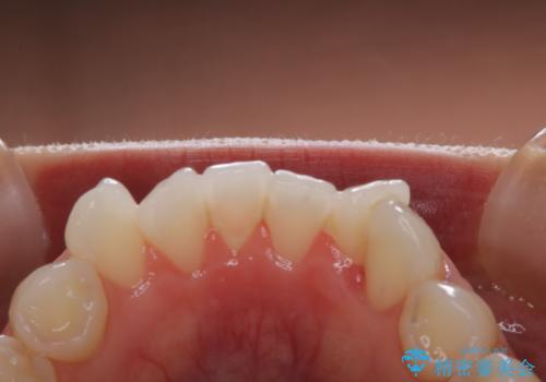 成人式の前撮り前に歯をきれいにしたい 初めてのPMTCの治療前