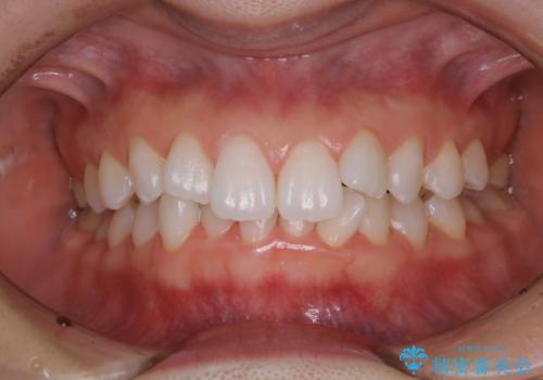 成人式の前撮り前に歯をきれいにしたい 初めてのPMTCの治療後