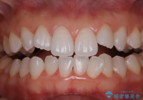 成人式の前撮り前に歯をきれいにしたい 初めてのPMTCの症例 治療後