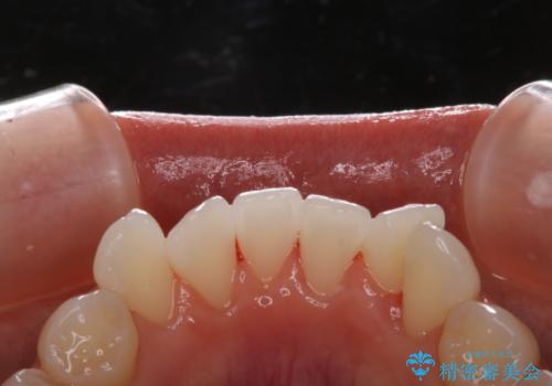 成人式の前撮り前に歯をきれいにしたい 初めてのPMTCの治療後