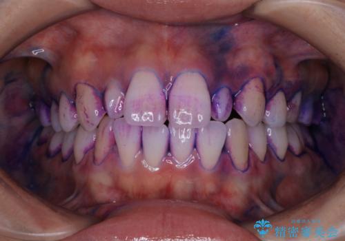 1カ月前に他院でクリーニングを受けたが舌触りが気になる PMTCでツルツルにの治療前