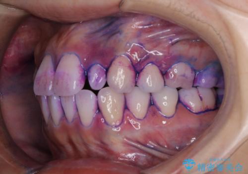 1カ月前に他院でクリーニングを受けたが舌触りが気になる PMTCでツルツルにの治療前