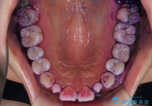 1カ月前に他院でクリーニングを受けたが舌触りが気になる PMTCでツルツルにの治療前
