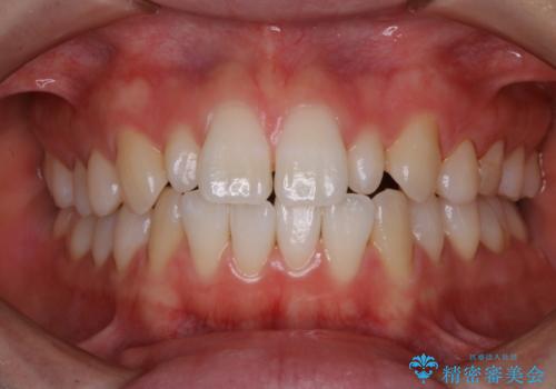 1カ月前に他院でクリーニングを受けたが舌触りが気になる PMTCでツルツルにの治療後