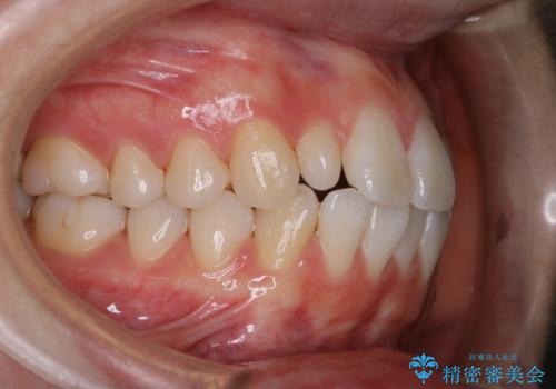 1カ月前に他院でクリーニングを受けたが舌触りが気になる PMTCでツルツルにの症例 治療後