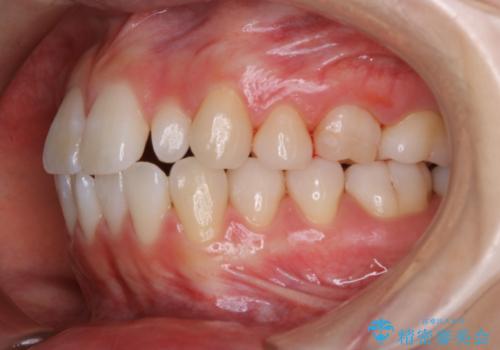 1カ月前に他院でクリーニングを受けたが舌触りが気になる PMTCでツルツルにの治療後