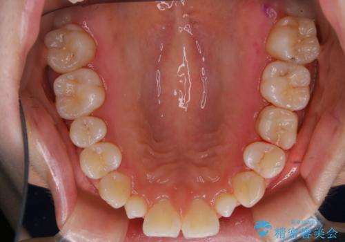 1カ月前に他院でクリーニングを受けたが舌触りが気になる PMTCでツルツルにの治療後