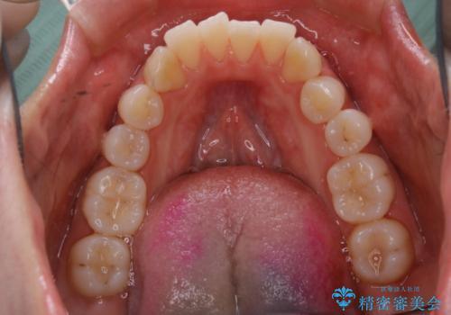 1カ月前に他院でクリーニングを受けたが舌触りが気になる PMTCでツルツルにの治療後