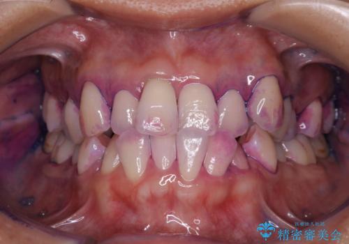 矯正治療が始まる前に歯磨きチェックとクリーニングの治療前
