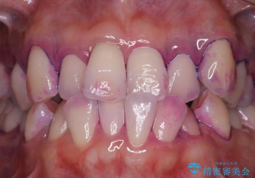 矯正治療が始まる前に歯磨きチェックとクリーニングの治療前