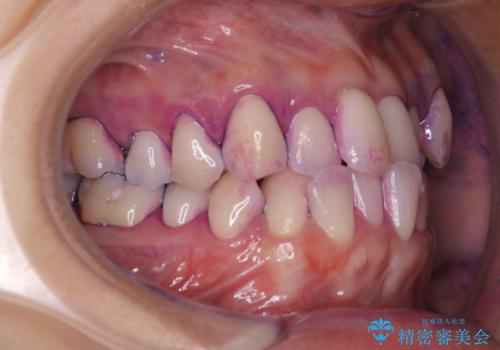 矯正治療が始まる前に歯磨きチェックとクリーニングの治療前