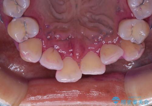 矯正治療が始まる前に歯磨きチェックとクリーニングの治療前