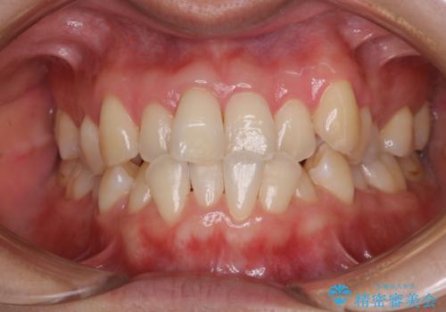 矯正治療が始まる前に歯磨きチェックとクリーニングの治療後