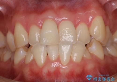 矯正治療が始まる前に歯磨きチェックとクリーニングの治療後
