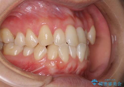 矯正治療が始まる前に歯磨きチェックとクリーニングの治療後