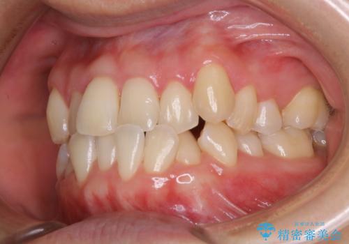 矯正治療が始まる前に歯磨きチェックとクリーニングの症例 治療後