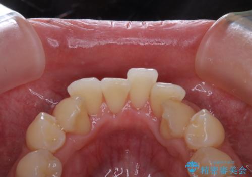 矯正治療が始まる前に歯磨きチェックとクリーニングの治療後