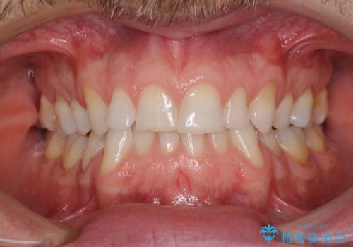 抜歯矯正の後戻りが気になる インビザライン・ライトによる矯正治療の症例 治療前