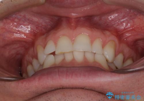 抜歯矯正の後戻りが気になる インビザライン・ライトによる矯正治療の治療前