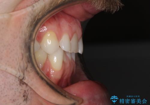 抜歯矯正の後戻りが気になる インビザライン・ライトによる矯正治療の治療前