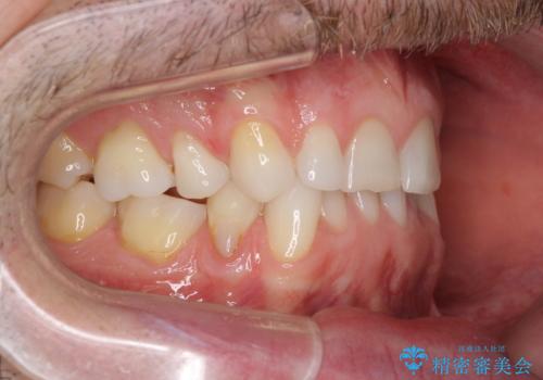 抜歯矯正の後戻りが気になる インビザライン・ライトによる矯正治療の治療前