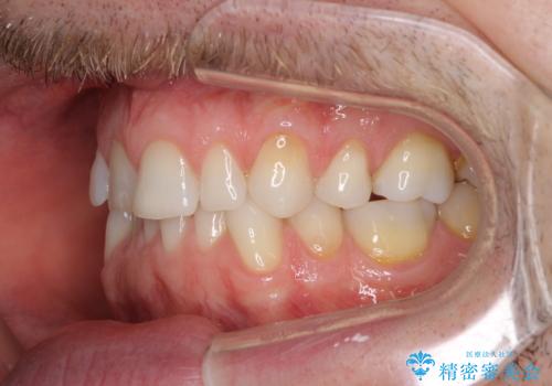 抜歯矯正の後戻りが気になる インビザライン・ライトによる矯正治療の治療前