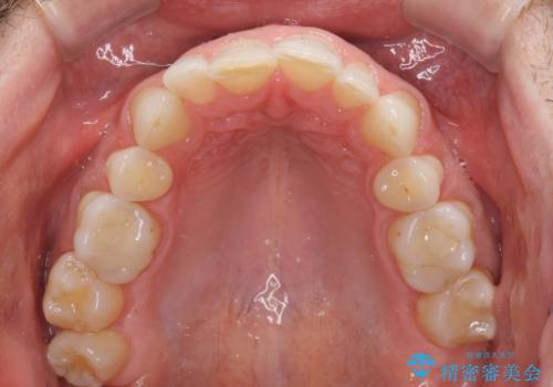 抜歯矯正の後戻りが気になる インビザライン・ライトによる矯正治療の治療前