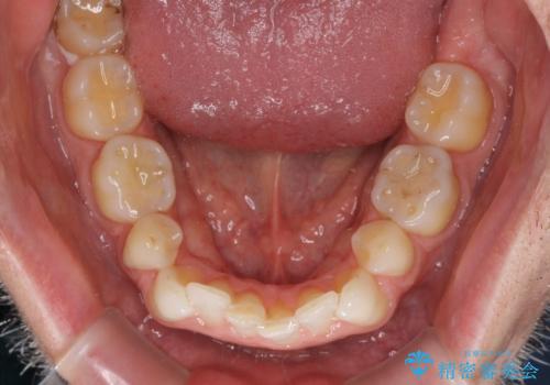 抜歯矯正の後戻りが気になる インビザライン・ライトによる矯正治療の治療前