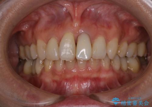 前歯の治療中にきれいに歯のクリーニングの治療前