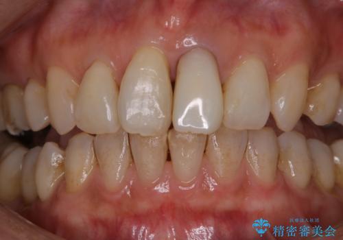 前歯の治療中にきれいに歯のクリーニングの症例 治療前