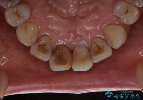 前歯の治療中にきれいに歯のクリーニングの治療前