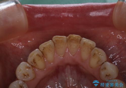 前歯の治療中にきれいに歯のクリーニングの治療前