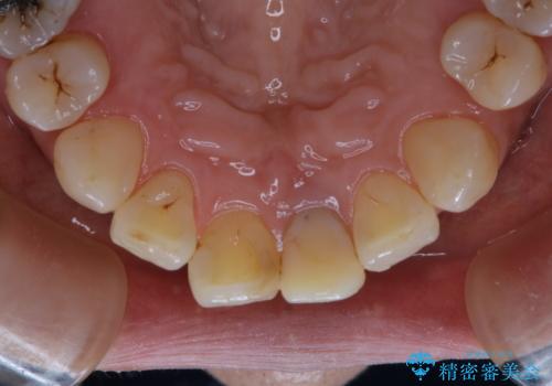 前歯の治療中にきれいに歯のクリーニングの治療後