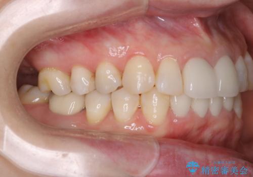 インプラントの2次手術前にPMTCで清潔な口腔内にの治療前