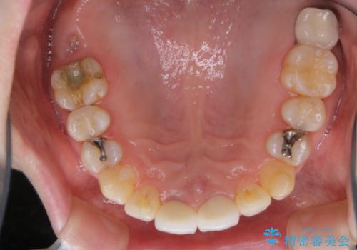 インプラントの2次手術前にPMTCで清潔な口腔内にの治療前