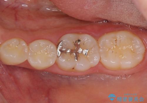 セラミックとゴールド　奥歯のむし歯治療の症例 治療前