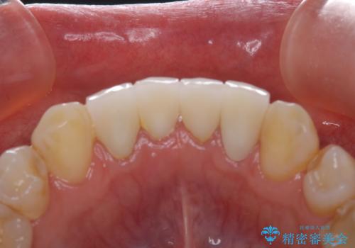 インプラントの2次手術前にPMTCで清潔な口腔内にの治療前