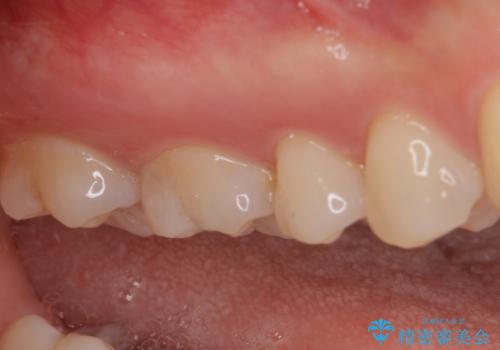 セラミックとゴールド 奥歯のむし歯治療の治療前