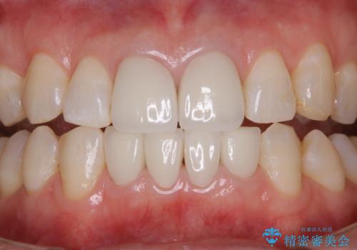 インプラントの2次手術前にPMTCで清潔な口腔内にの治療後