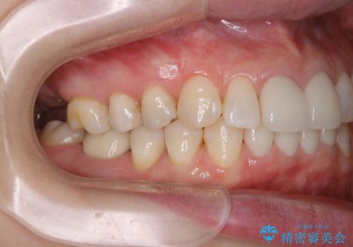 インプラントの2次手術前にPMTCで清潔な口腔内にの治療後