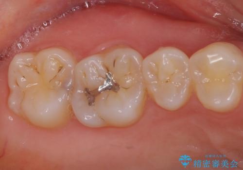 セラミックとゴールド 奥歯のむし歯治療の治療前