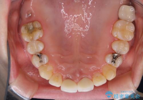 インプラントの2次手術前にPMTCで清潔な口腔内にの治療後