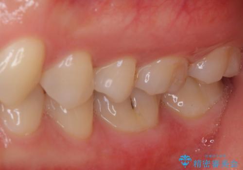 セラミックとゴールド 奥歯のむし歯治療の治療前