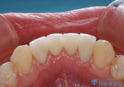 インプラントの2次手術前にPMTCで清潔な口腔内にの治療後