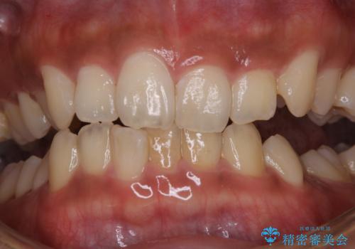 タバコによる着色をPMTCできれいな白い歯にの治療前