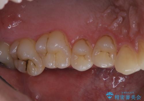 タバコによる着色をPMTCできれいな白い歯にの治療前