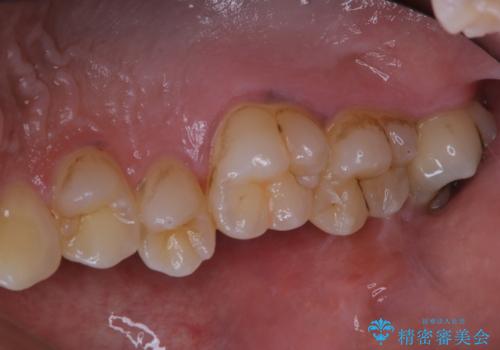タバコによる着色をPMTCできれいな白い歯にの治療前