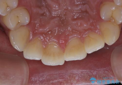 タバコによる着色をPMTCできれいな白い歯にの治療前