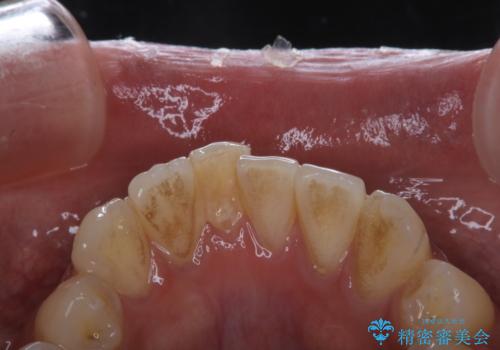 タバコによる着色をPMTCできれいな白い歯にの症例 治療前